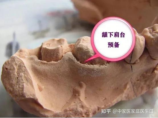 贵金属烤瓷肩台(贵金属烤瓷冠价格)